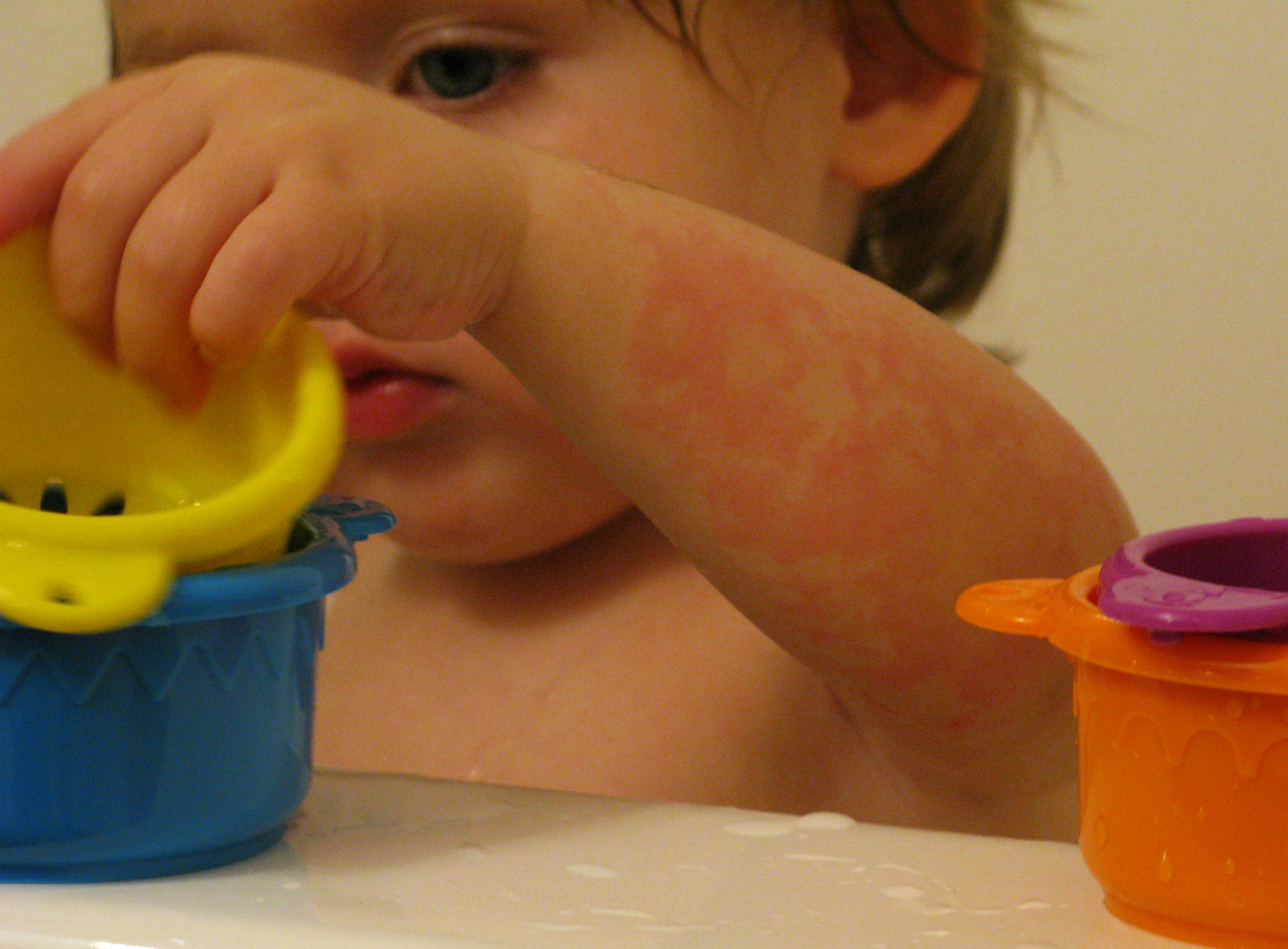 child playing toys ringworm infection on forearm