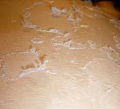 peeling skin