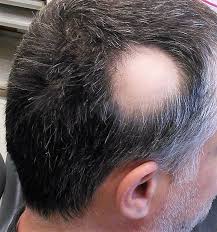 man head with alopecia baldness