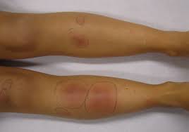 red swollen legs