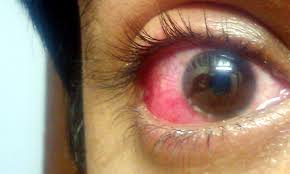 eye with conjunctivitis infection