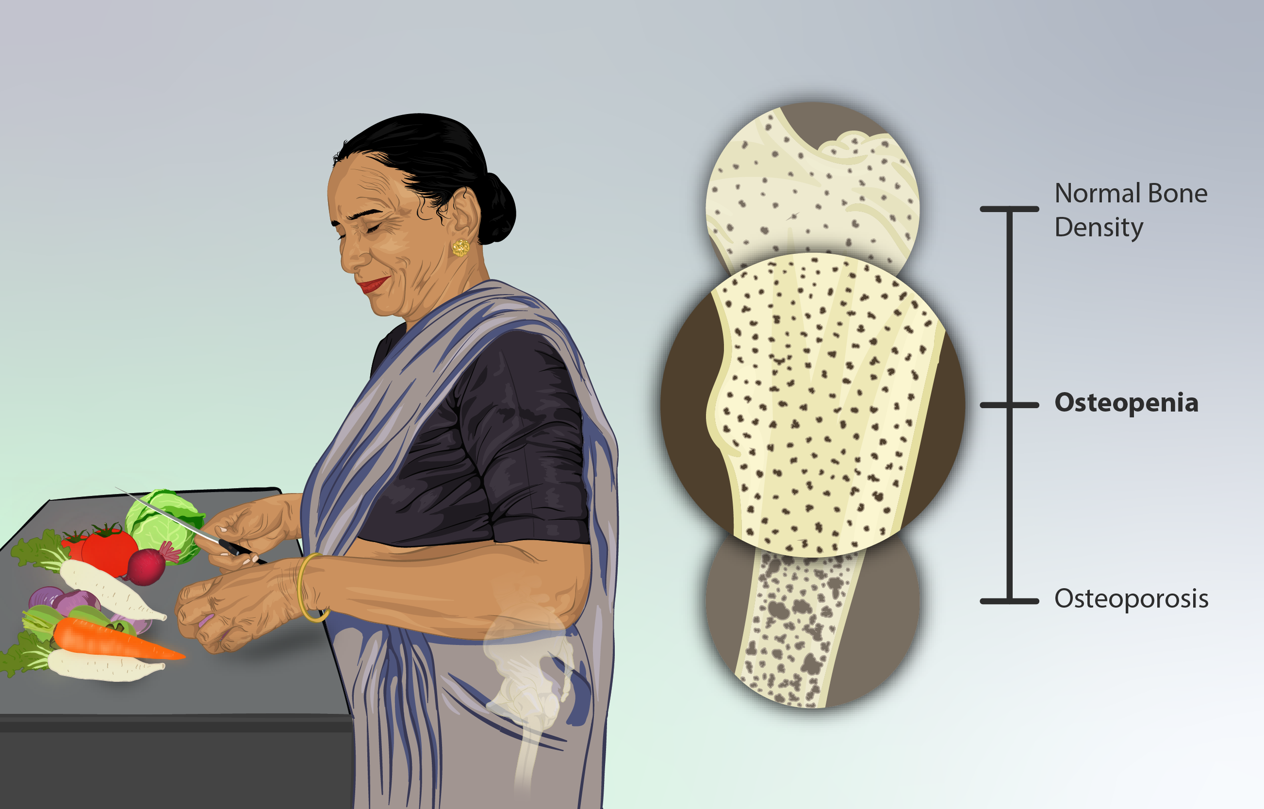 women suffering from osteopenia