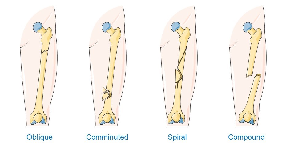 types of bone fracture