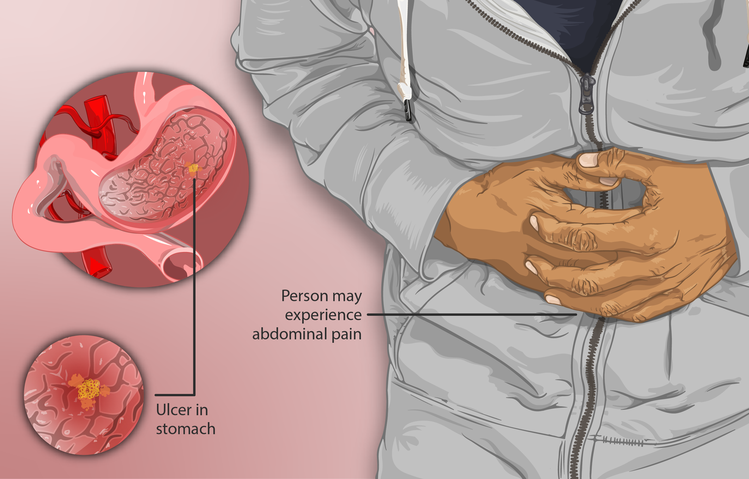 symptoms of ulcer