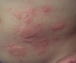 rash on skin