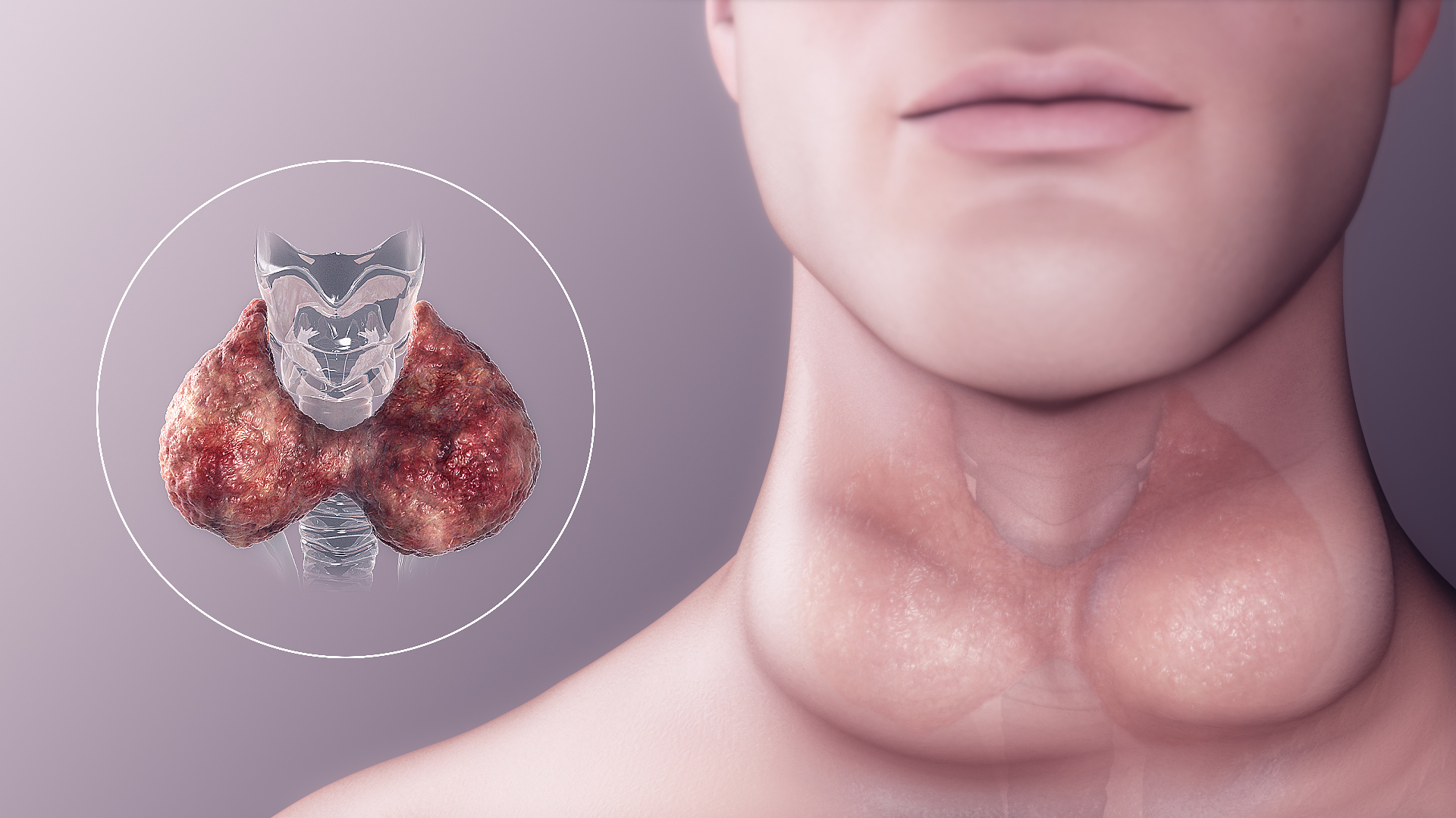 overactive thyroid