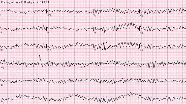 arrhythmia record