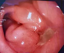 peptic ulcer inside the body