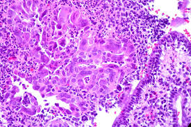 cervicitis stain