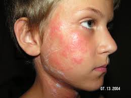 allergic reaction with rashes on the face