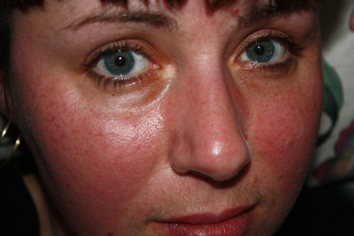 facial swelling