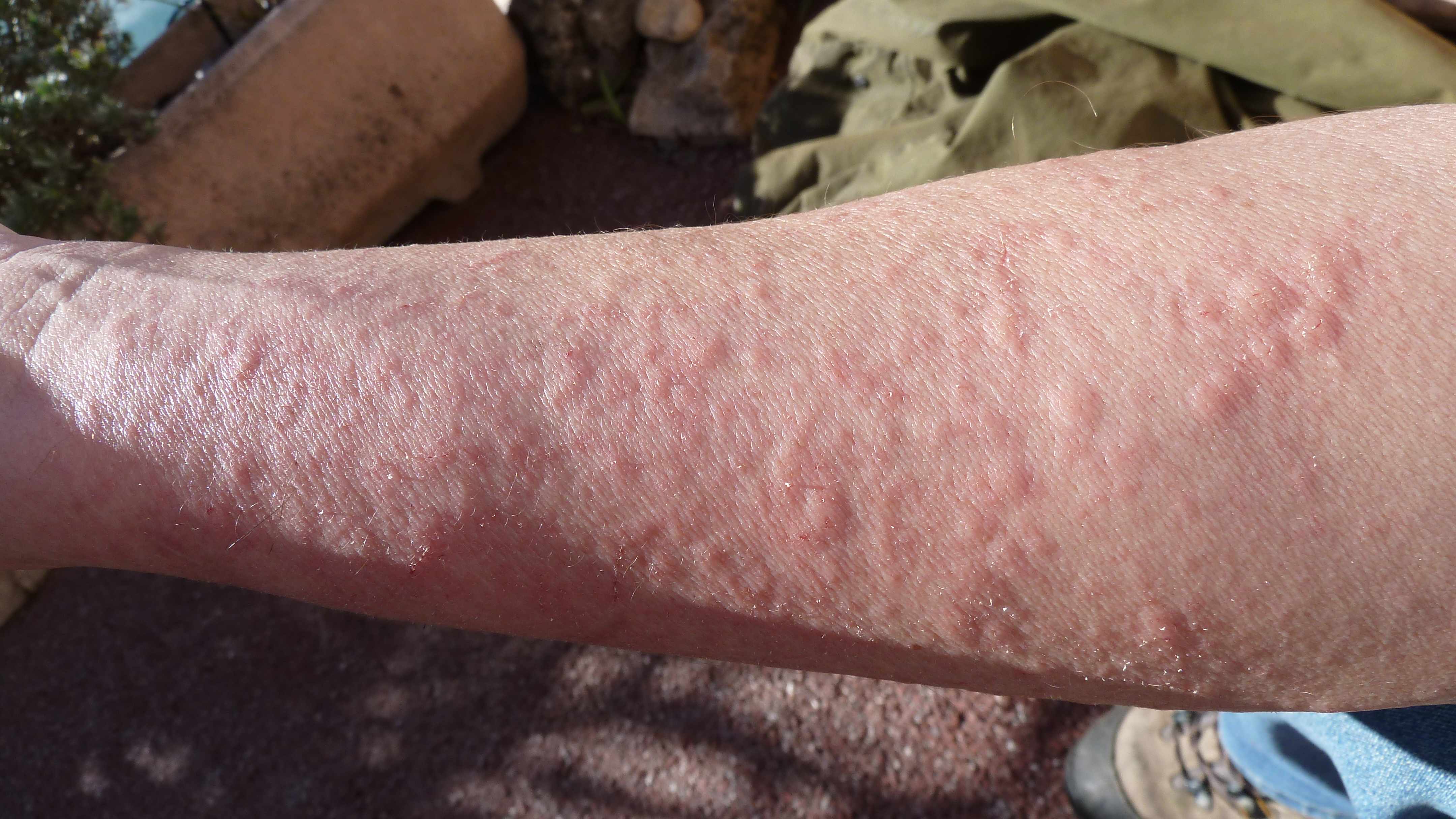allergic dermatitis on arm