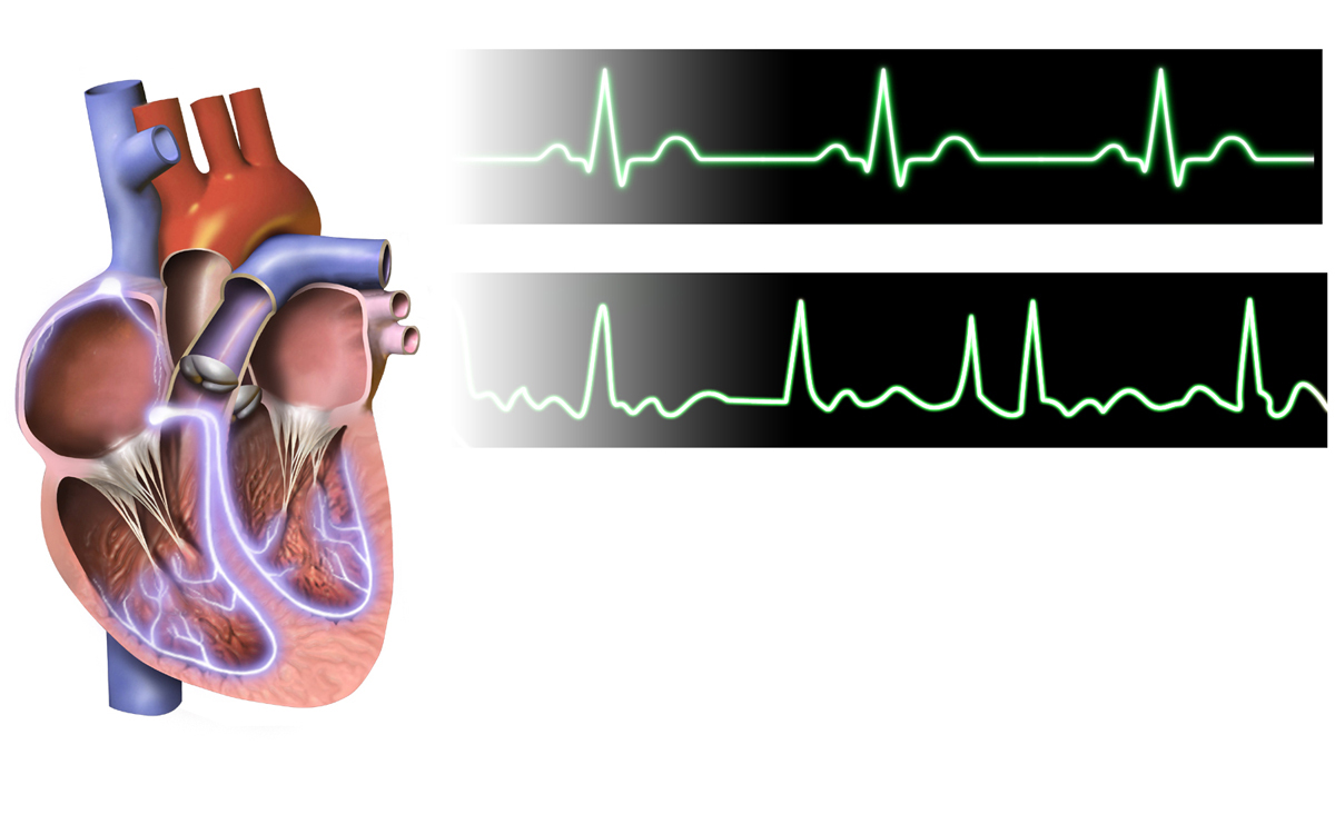 arrhythmia record
