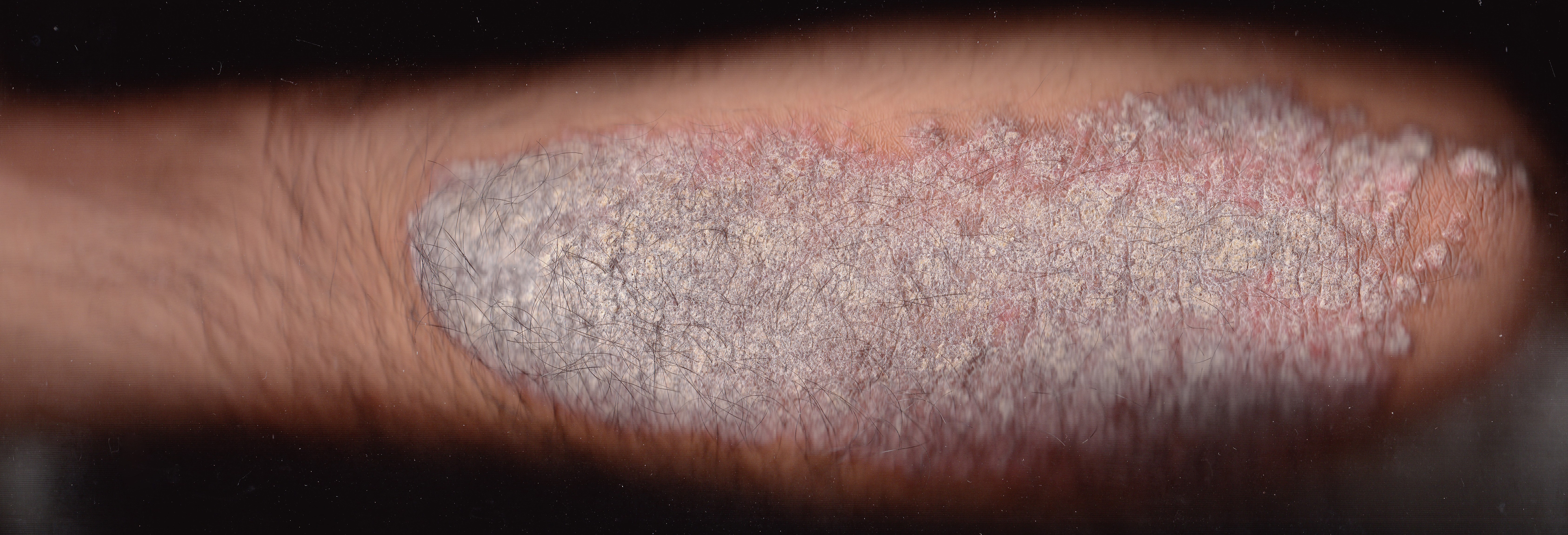 arm covered with plaque psoriasis
