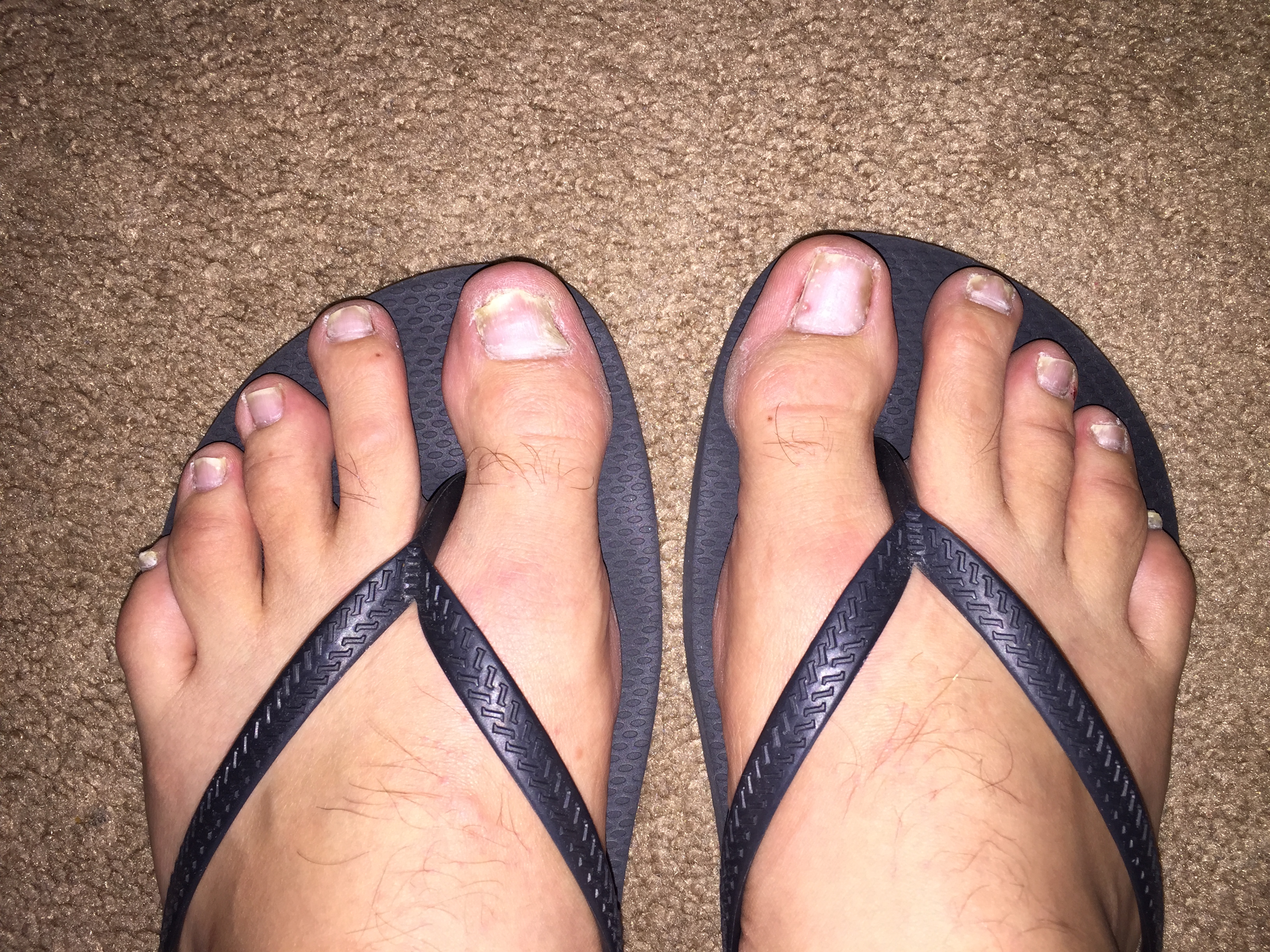 nail psoriasis on feet