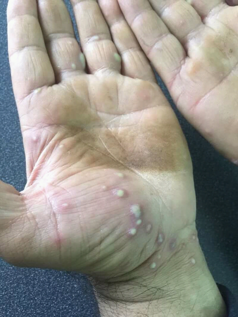 palmoplantar pustulosis on hand