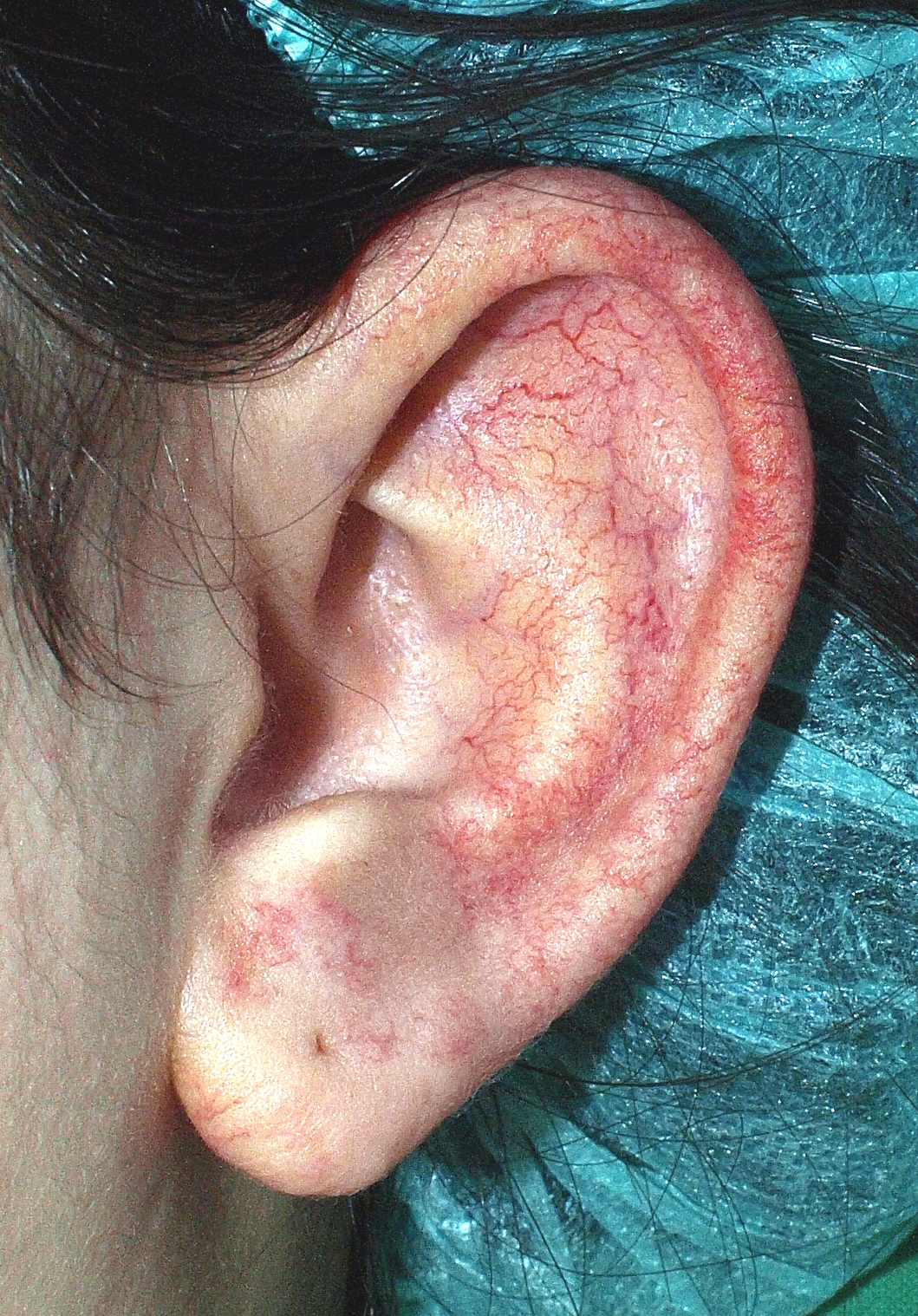 Telangiectasia on the ear