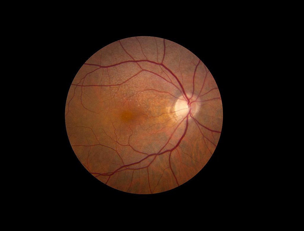 macular degeneration in the eyes