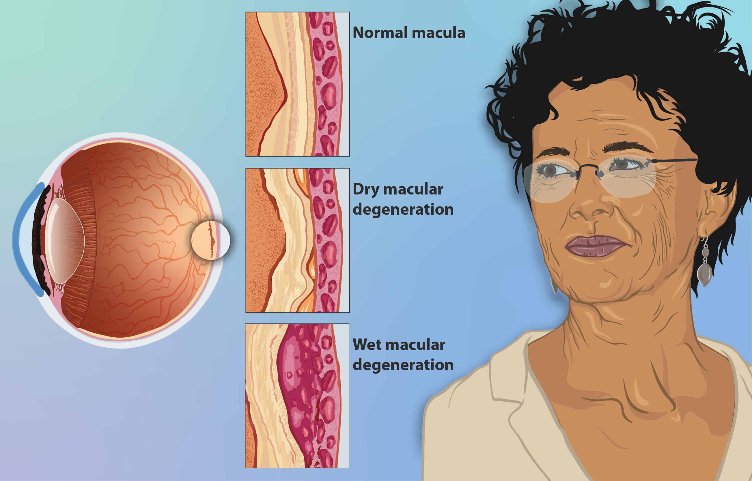 woman suffering from age-related macular degeneration