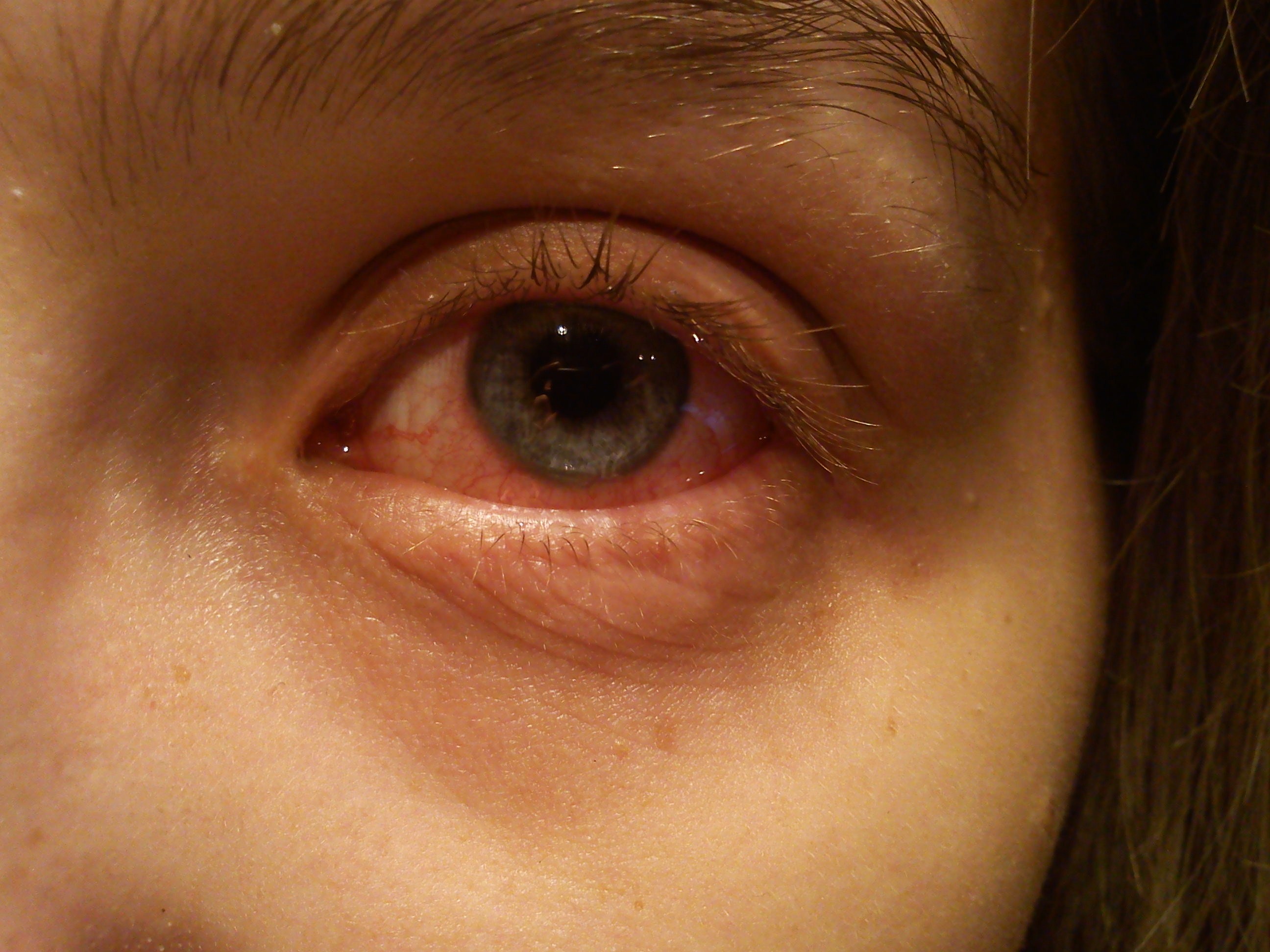 Fungal Eye Infection