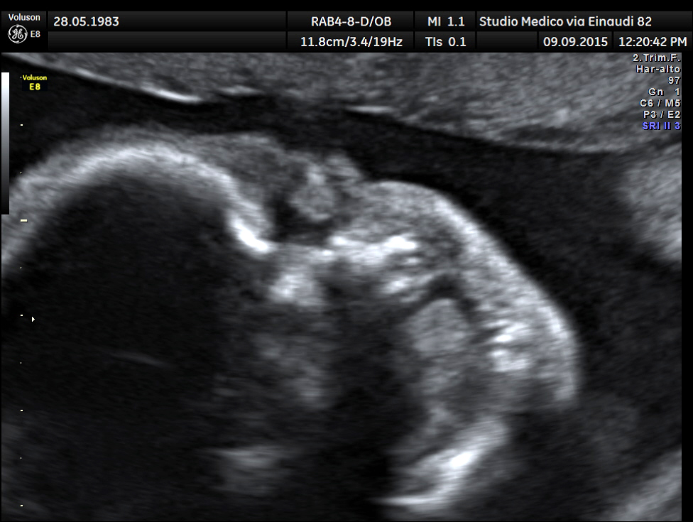 fetal ultrasound
