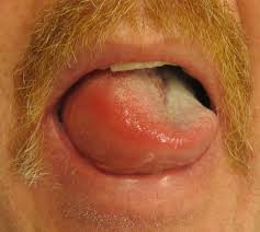 swelling of tongue