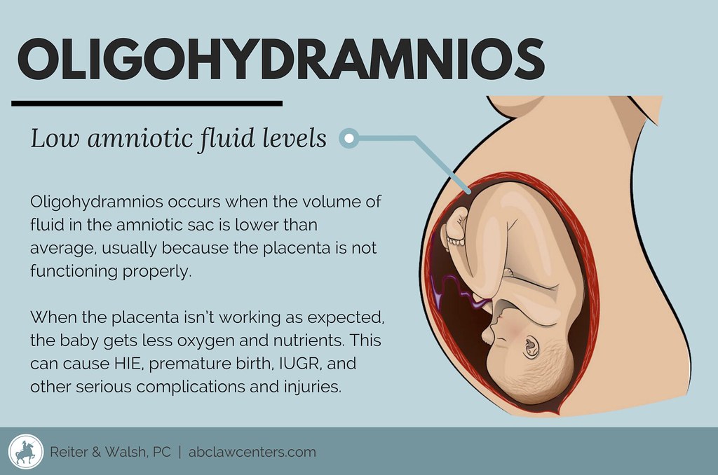 oligohydramnios