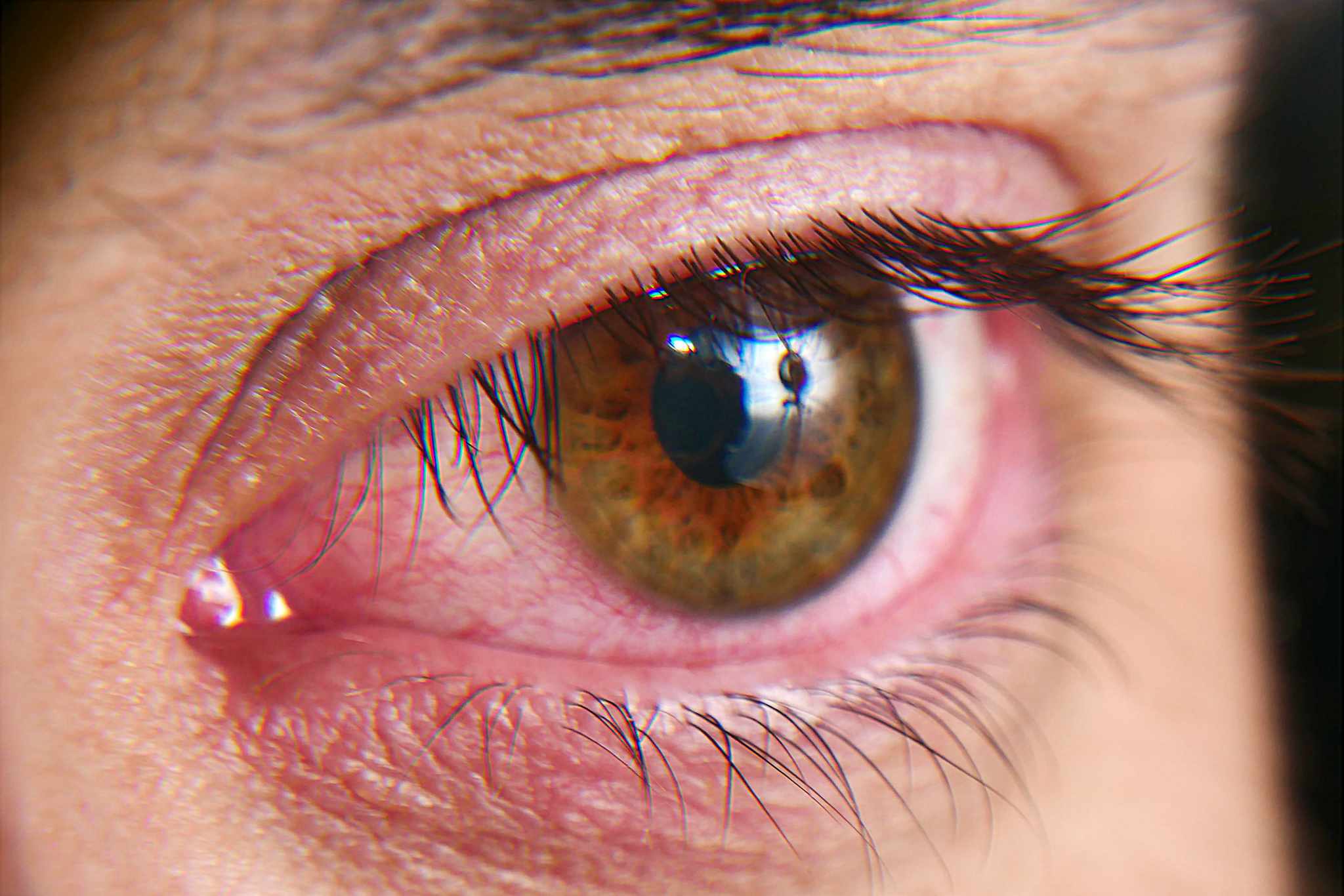red dry eyes of a woman
