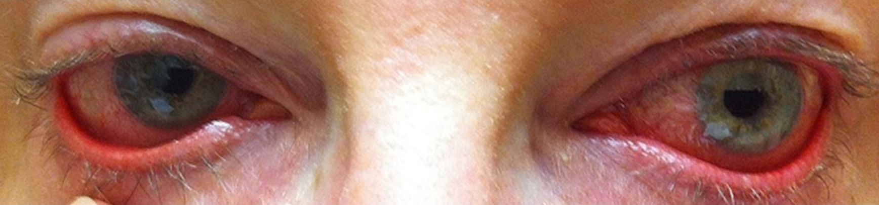 redness of the eyes
