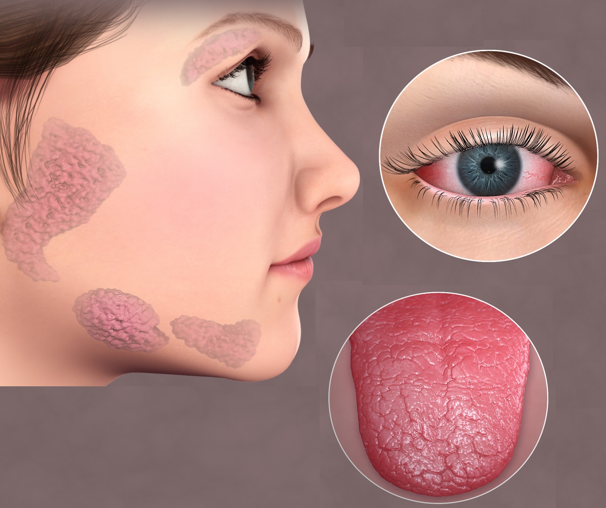 Sjögren’s syndrome symptoms