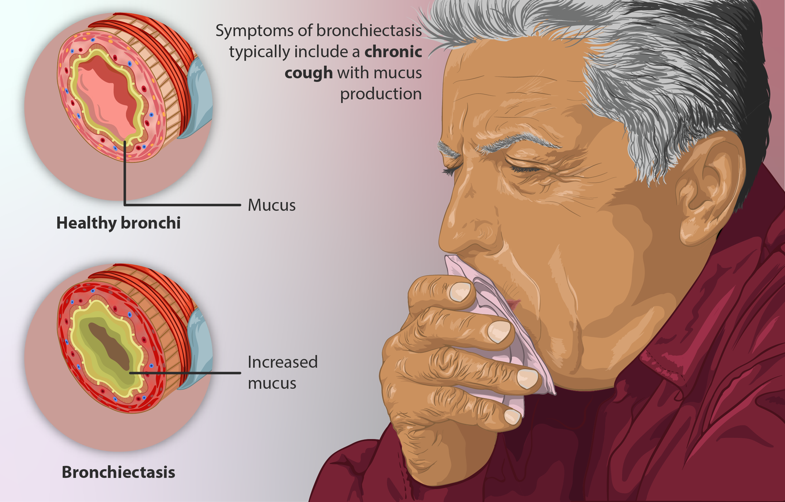 symptoms of Bronchiectasis