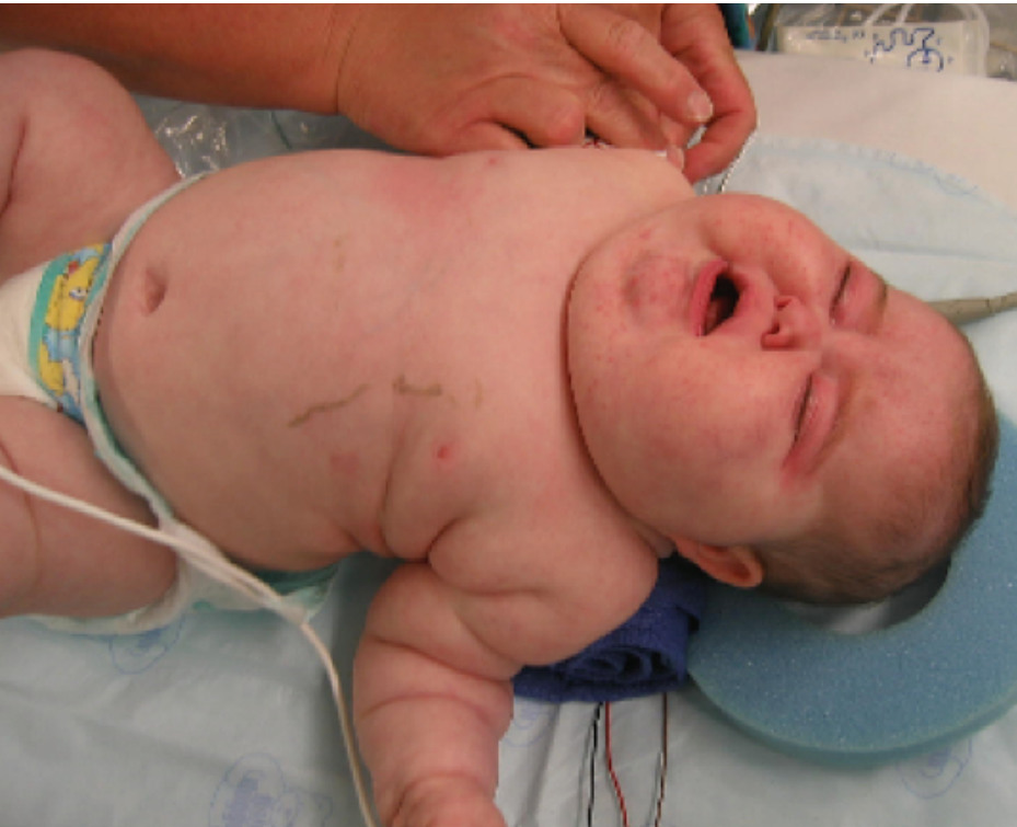 baby with cushingoid features