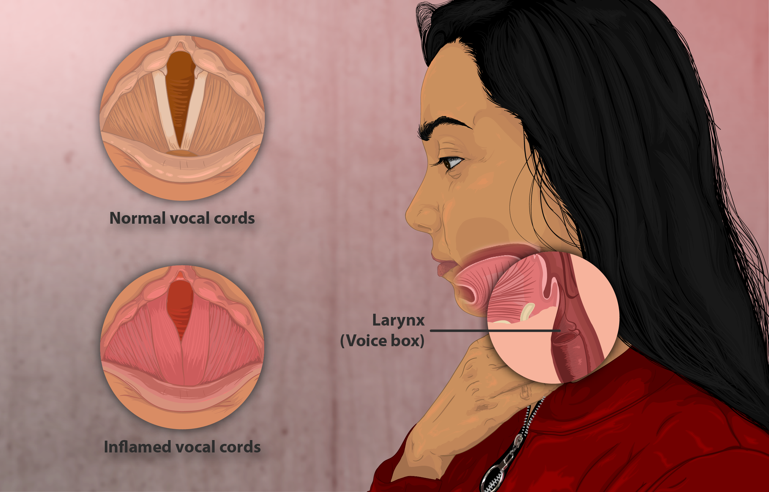 dysphonia symptoms