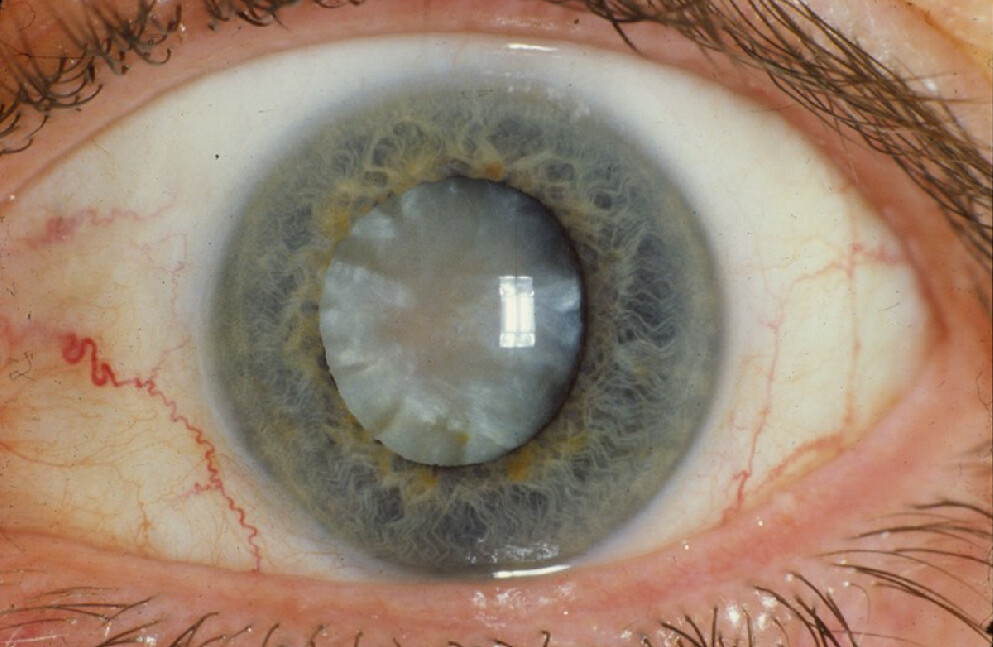 cataract clouding the eye