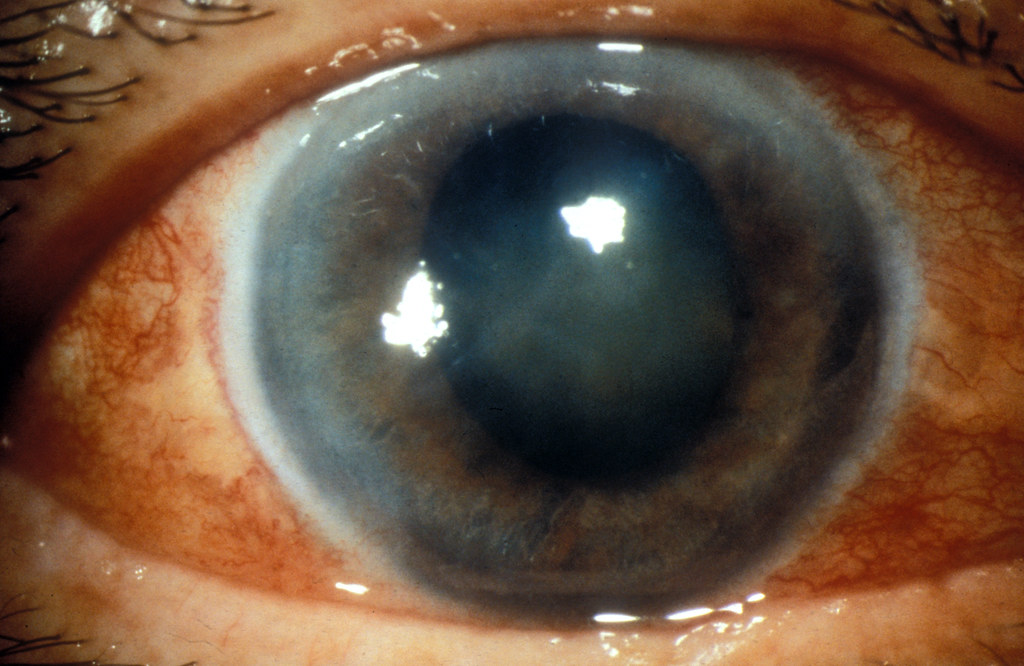 glaucoma types and vision