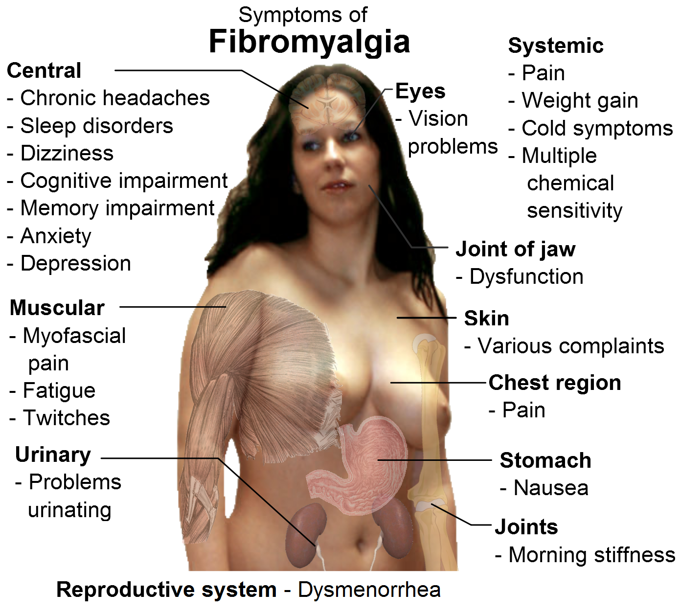 fibromyalgia symptoms in women