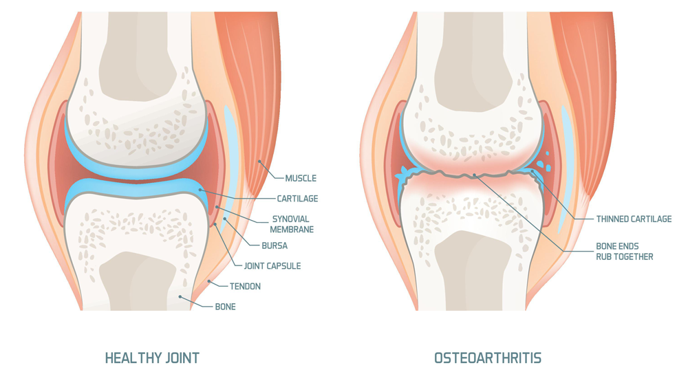 bones with osteoarthritis 