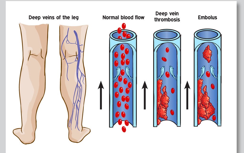 legs thrombosis 