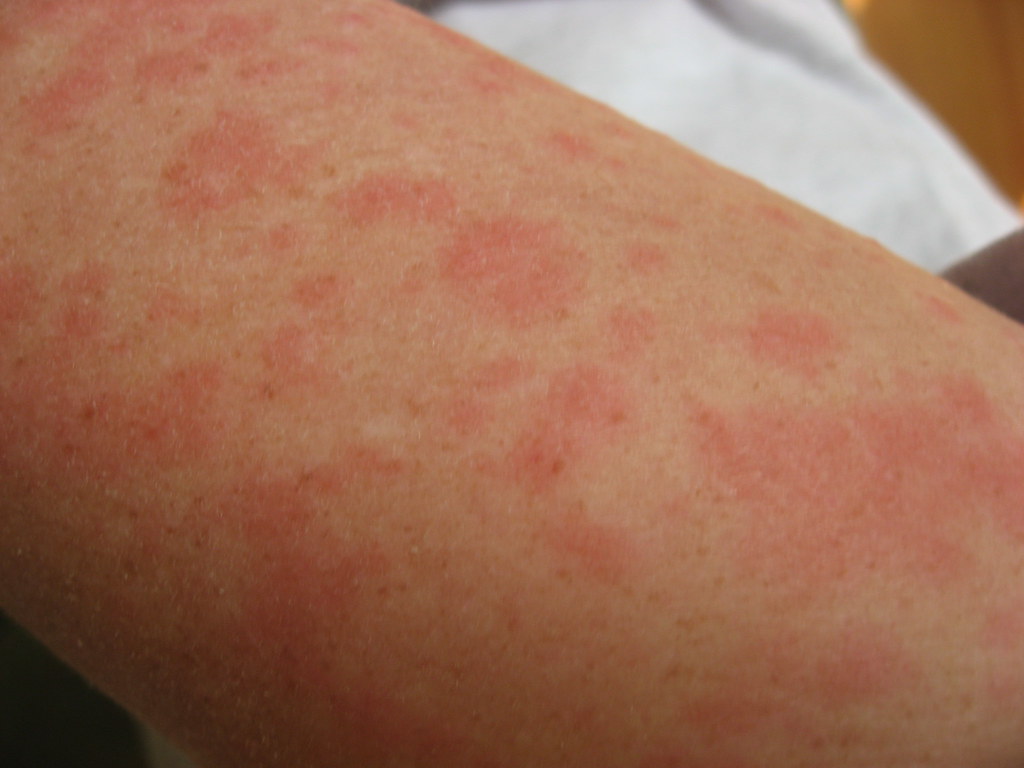 arm with hives on the skin red spots