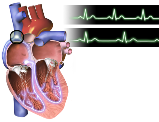 bradycardia heart