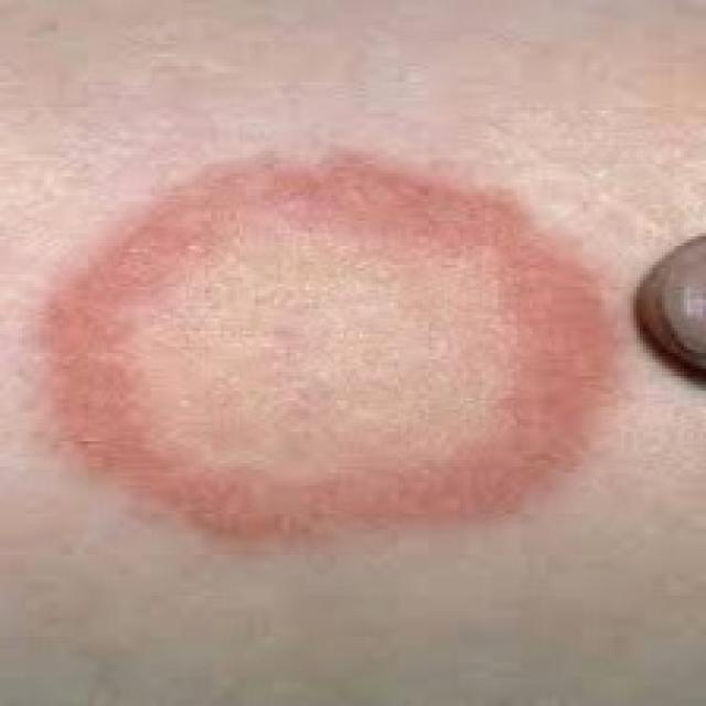 rounded fungal infection on skin