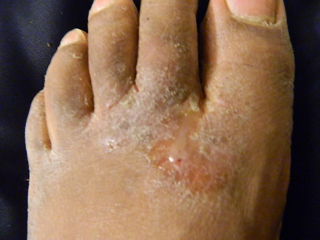 a foot with athlete's foot disease