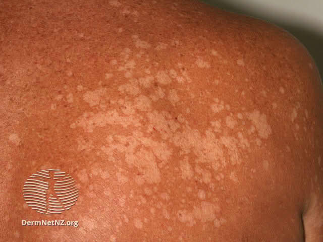 pityriasis versicolor of the back