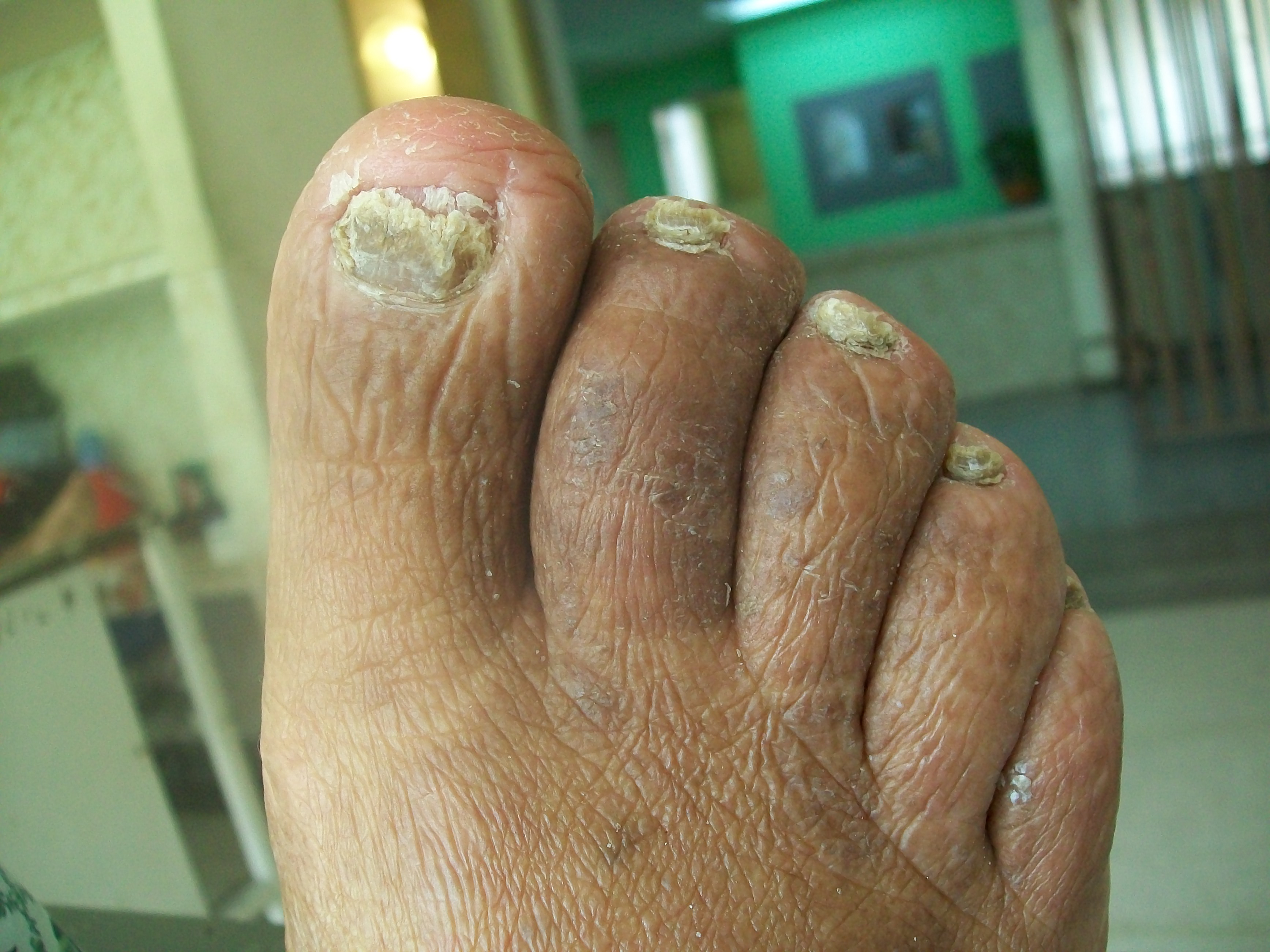onychomycosis