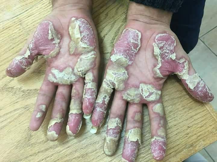 pustular psoriasis of the hand