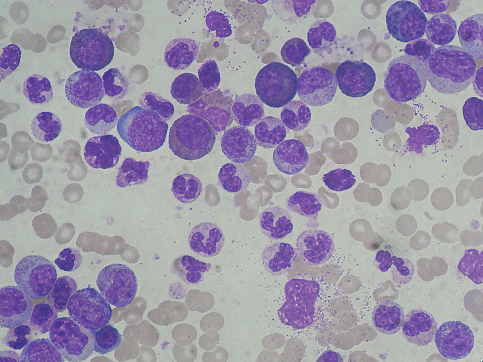 Chronic Myeloid Leukemia (CML) Smear