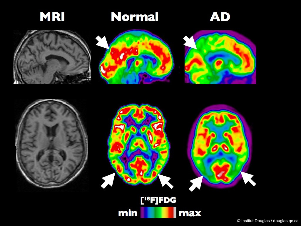 mri scan of brain with alzheimer's