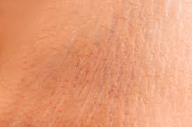 belly stretch marks