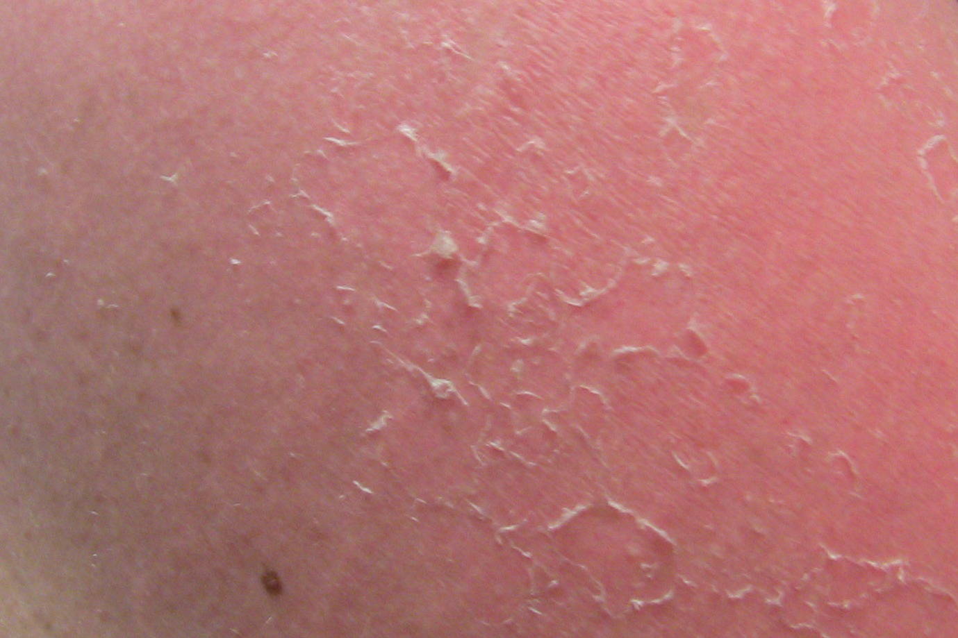 skin red because of peeling
