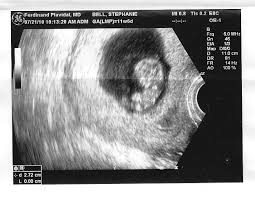 ultrasound of baby